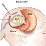 Craniotomy