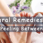 natural remedies for skin peeling toes