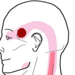 Nummular Headache