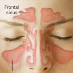 Sinusitis Headache