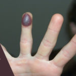 six home remedies to heal the blood blister
