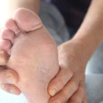 skin peeling between toes