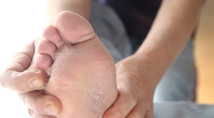 Skin Peeling Between Toes: Causes & Treatment skin peeling between toes