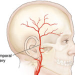 Temporal Arteritis