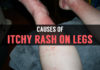 causes of itchy rash on legs