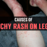 causes of itchy rash on legs