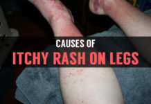 Itchy Rash On Legs: Is It A Serious Problem causes of itchy rash on legs