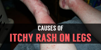 causes of itchy rash on legs