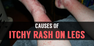 Itchy Rash On Legs: Is It A Serious Problem causes of itchy rash on legs