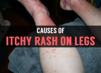 Itchy Rash On Legs: Is It A Serious Problem causes of itchy rash on legs
