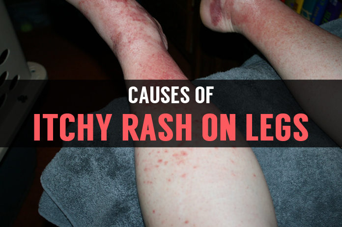 causes of itchy rash on legs