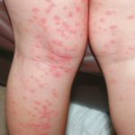 itchy red rash and spots on legs