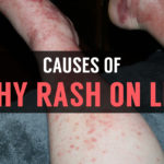 rashes affecting the lower legs with serious problem