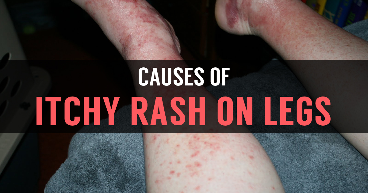 Skin Rash On Legs