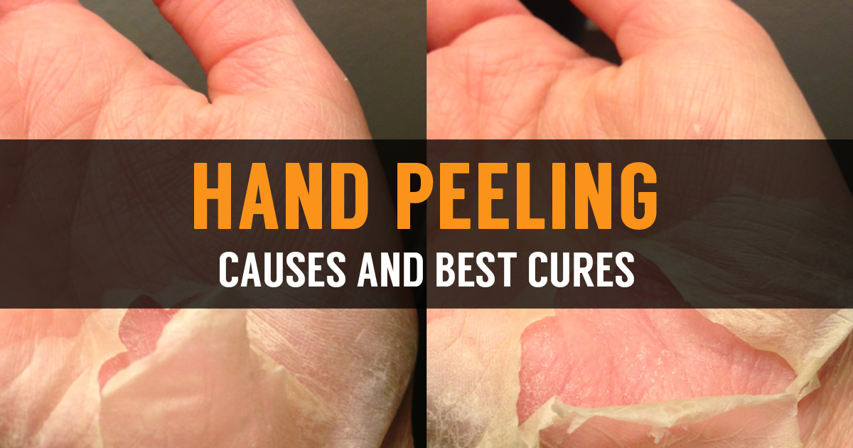 Reasons for skin peeling on hands | Home Easy Natural Remedies