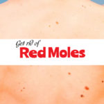 get rid of red moles
