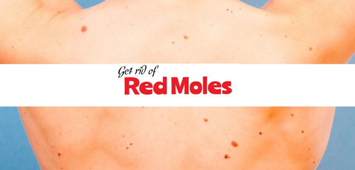 get rid of red moles