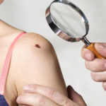 how to get rid of moles