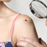 red moles on skin