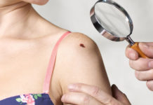 How To Get Rid of Red Moles? red moles on skin