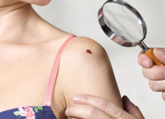How To Get Rid of Red Moles? red moles on skin