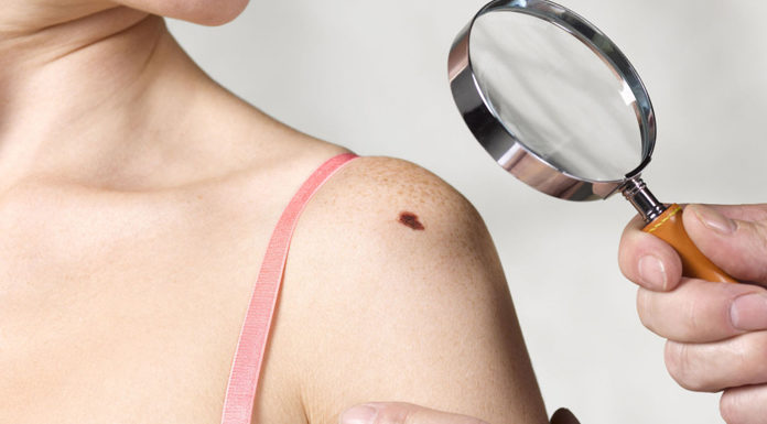 How To Get Rid of Red Moles? red moles on skin
