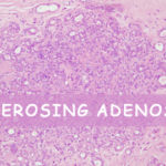 Sclerosing Adenosis