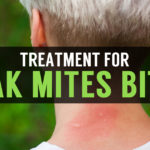 how to treat oak mites bites