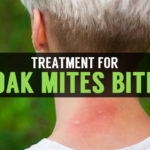 treatment for oak mites bite