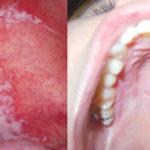causes of roof of mouth sore