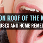roof of the mouth sore and causes and home remedies