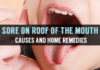 sore on roof of the mouth causes and home remedies