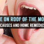 sore on roof of the mouth causes and home remedies