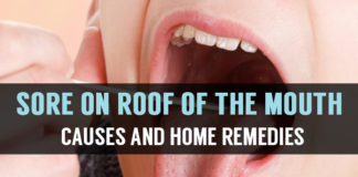What is Roof of the Mouth Sores? Causes and Home Remedies sore on roof of the mouth causes and home remedies