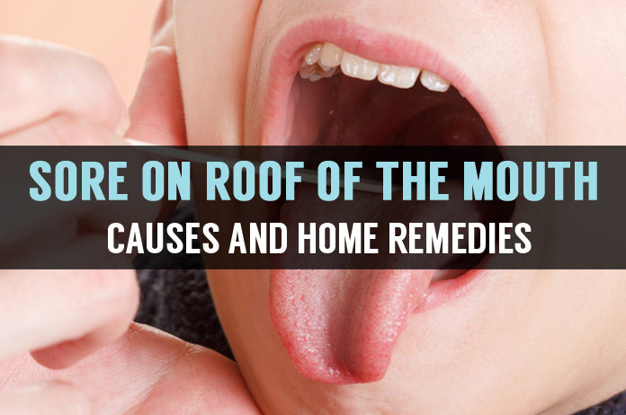 sore on roof of the mouth causes and home remedies