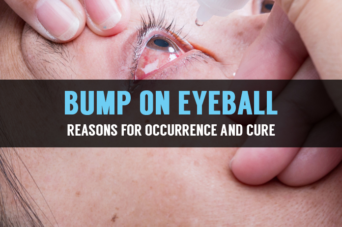 Bump On Eyeball Reasons For Occurrence And Cure