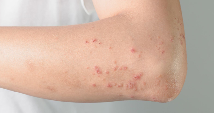 Itchy Bumps On Elbows Causes And Natural Treatment