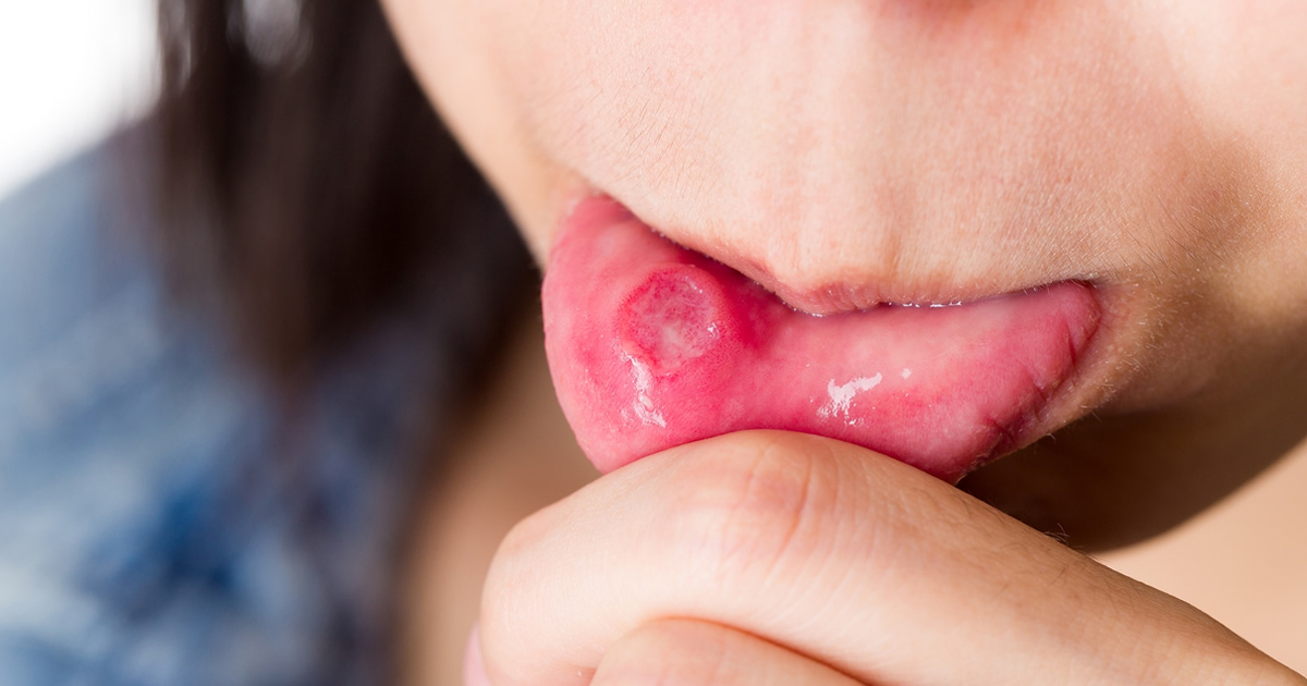 Find All Essential Oils For Canker Sores And Mouth Ulcers