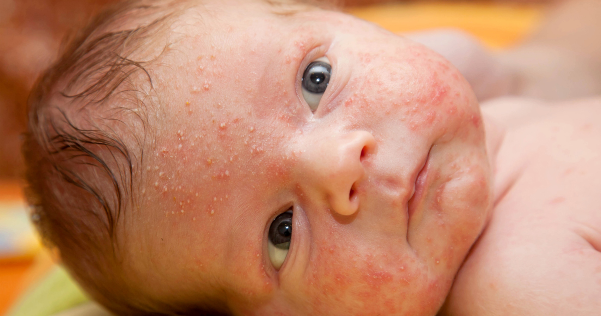 Learn How to Get rid of Eczema Natural Home Remedies for Eczema