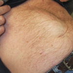 diastasis recti in men