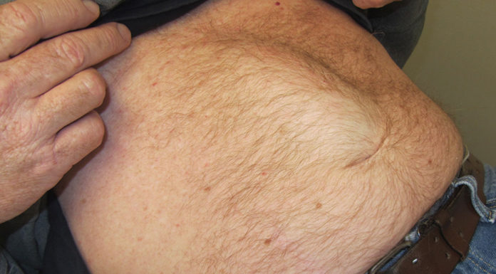 What Are Diastasis Recti? Symptoms, Causes, Diagnose and Treatment diastasis recti in men