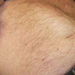diastasis recti in men causes and treatment