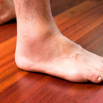 hair loss on legs