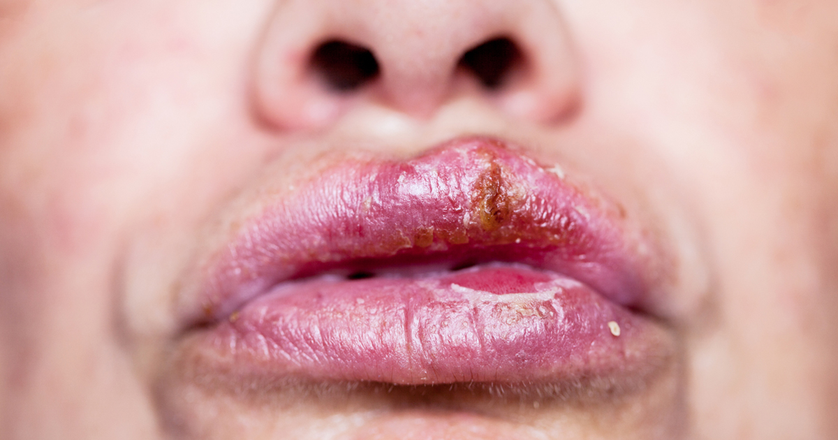 Lip Infection Bacterial Infections On Lips Learn All Causes And Treatment 