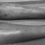 how to cure hair loss on legs on male and female