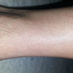 reasons for hair loss on lower legs