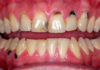 Black Spots On Gums Near Tooth: Causes, Treatment black spots on gums near tooth