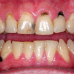 black spots on gums near tooth