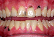 black spots on gums near tooth