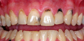 Black Spots On Gums Near Tooth: Causes, Treatment black spots on gums near tooth